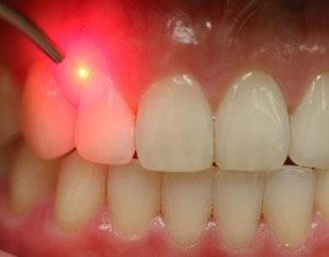 Laser-Gum-Treatment Gum-Disease-Health-Lasers