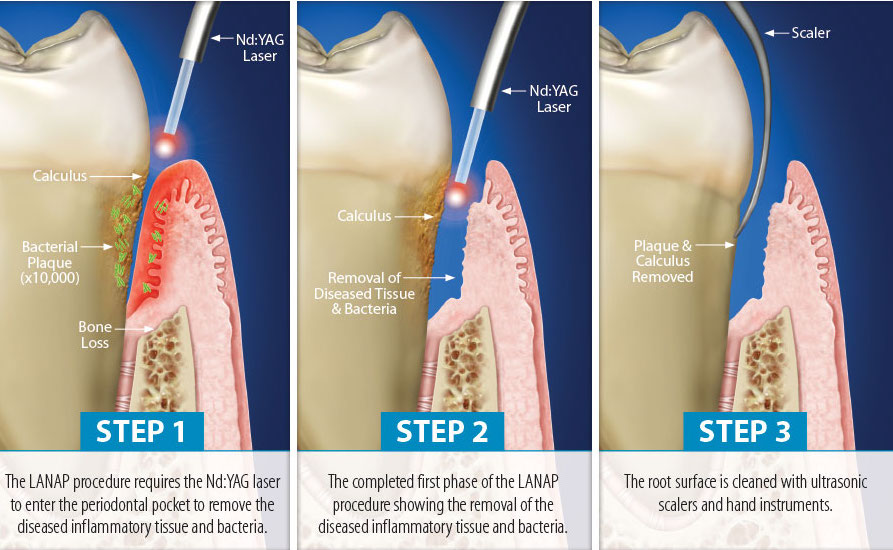 Gum-Disease-Health-Lasers