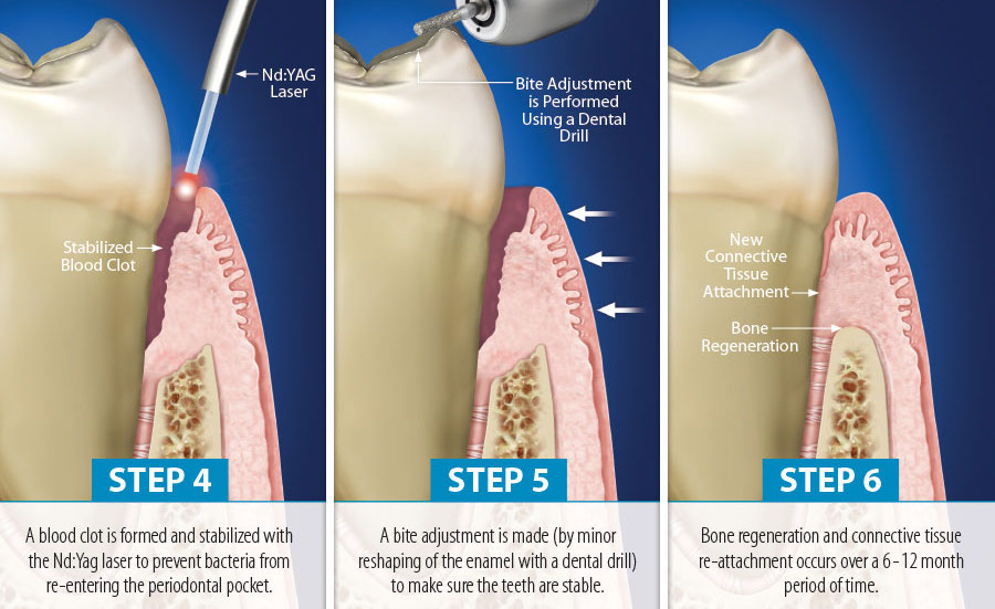 Gum-Disease-Health-Lasers
