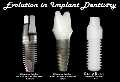 Ceramic Implants