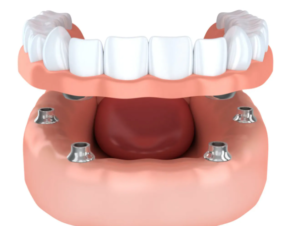 Dentures Supported Implants