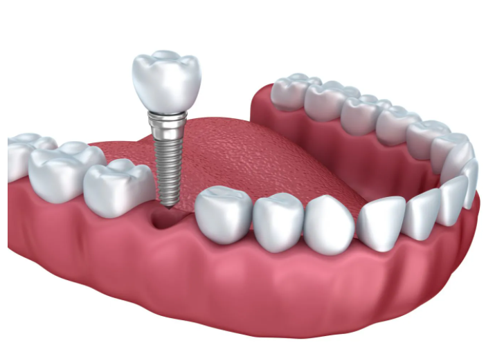 Dental Implant