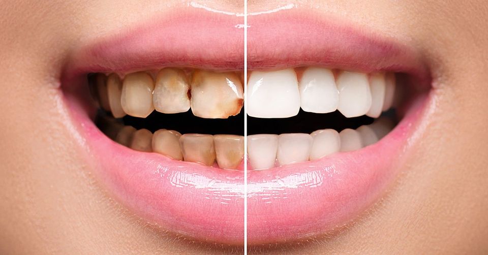 Porcelain Veneers