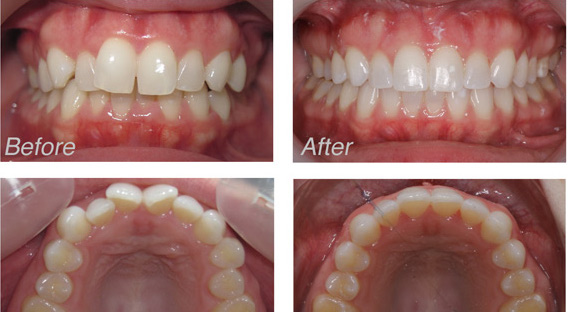 Best Invisalign Teeth
