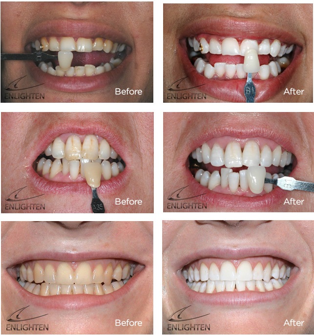 Enlighten Teeth Whitening-Solihull Birmingham