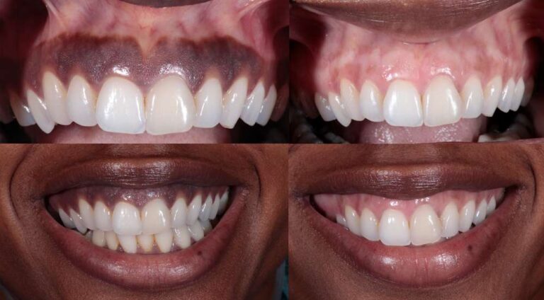 Laser Gum Pigmentation