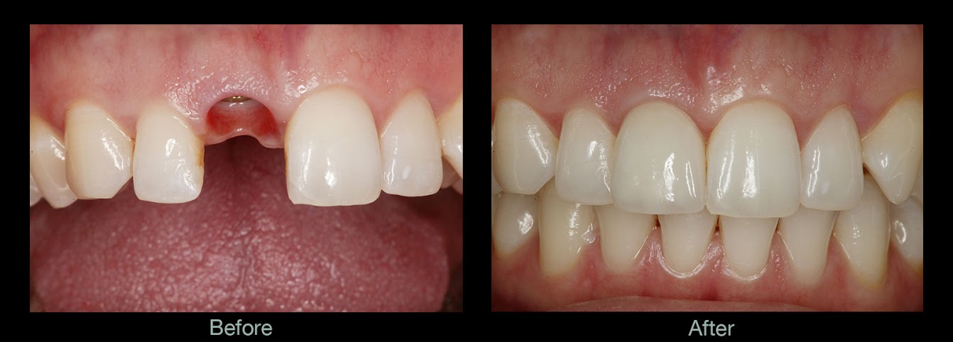 Single Implant