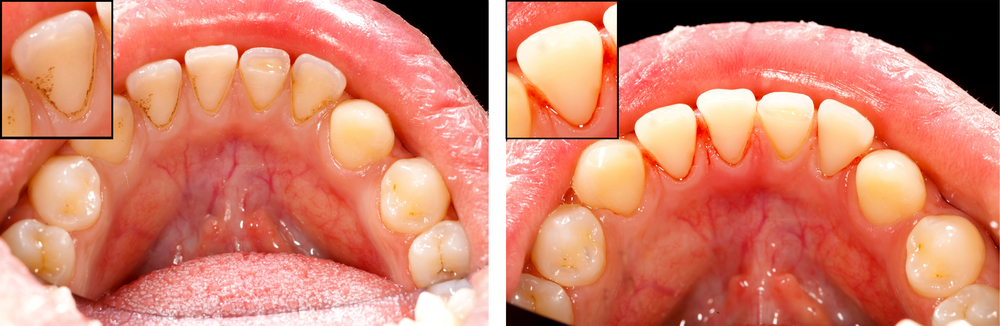 Gum Disease Treatment -Cleaned Teeth With Air Prophy Unit - Before And After.
