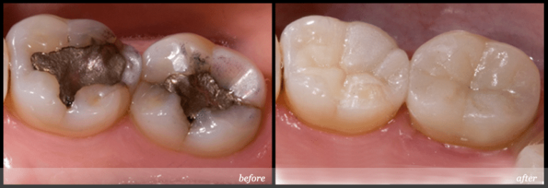 Silver Filling Removal In Birmingham