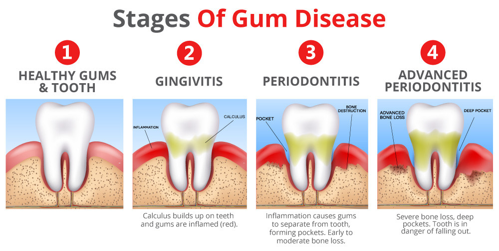 Gum Disease In Solihull