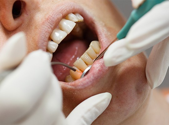 Laser Gum Treatment