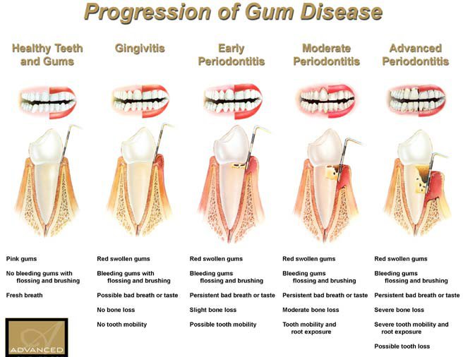 Periodontal-Disease