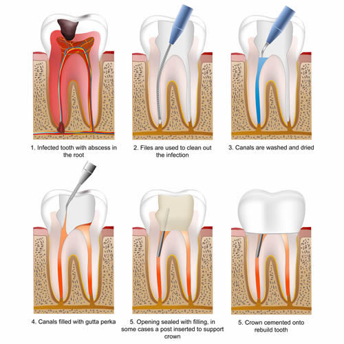 Root-Canal Treatment