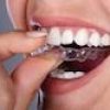 Clear Invisalign Braces