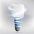Dental Implants Denture Implants Single And Multiple Implants