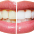 Teeth Whitening Home And Laser And Zoom